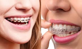 Invisalign4