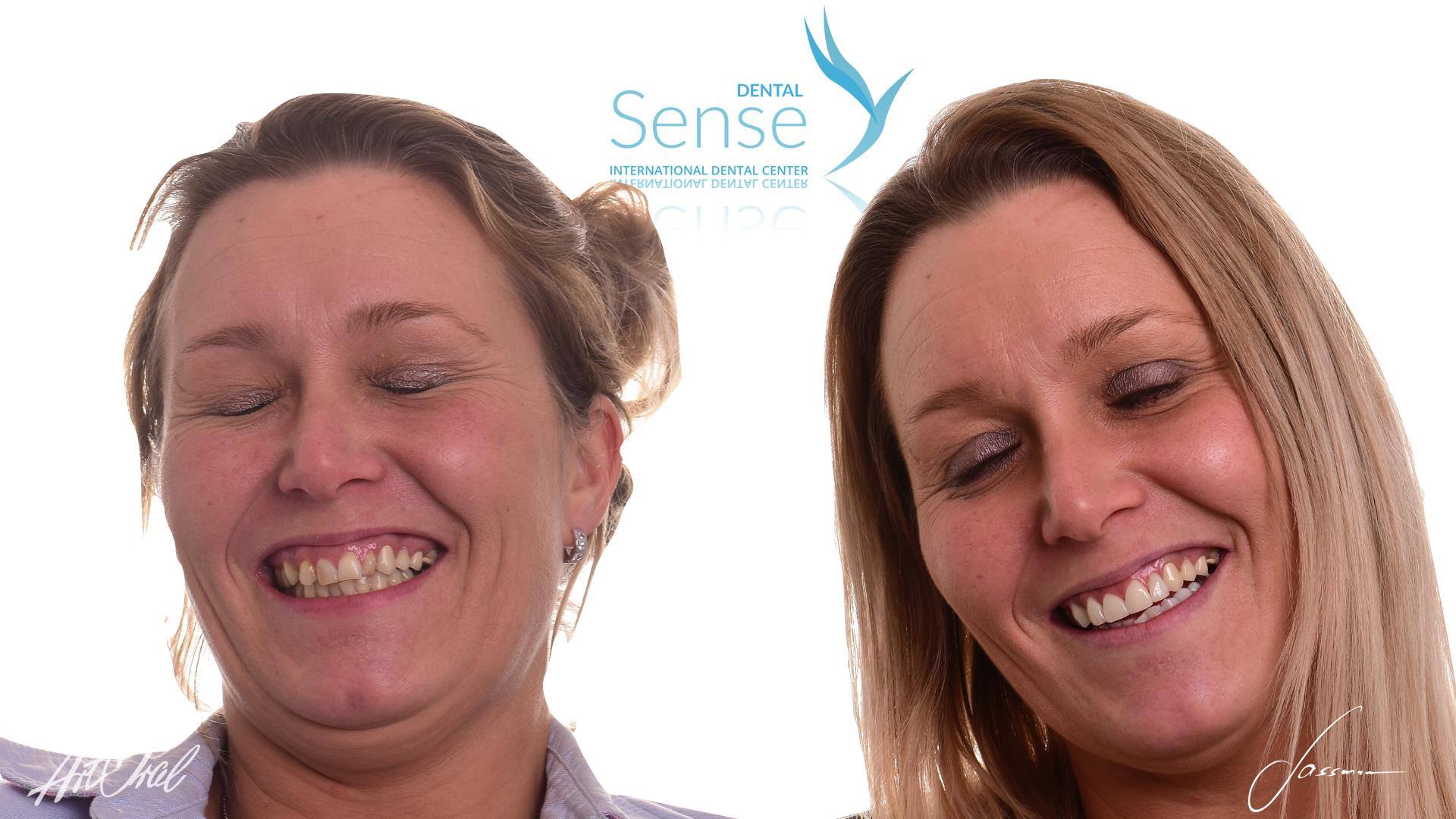 Cecilie Madsen Euromed Dental sense tannkroner