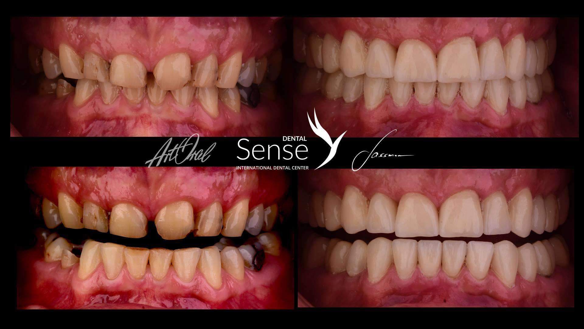 Euromed Dental sense tannkroner skallfasetter