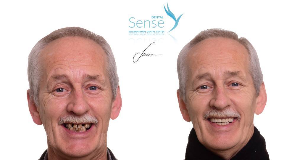 Weierud Euromed Dental sense tannkroner