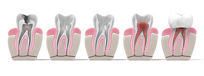 tannrotbehandling faser