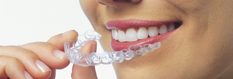 invisalign richmond hill